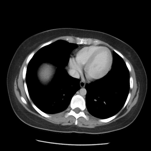 File:Borderline mucinous tumor (ovary) (Radiopaedia 78228-90808 A 61).jpg