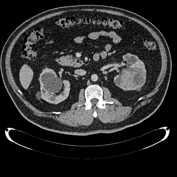 Bosniak renal cyst - type IV (Radiopaedia 24244-24518 C 146).jpg