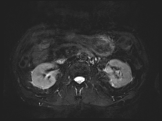 File:Bouveret syndrome (Radiopaedia 61017-68856 Axial MRCP 35).jpg