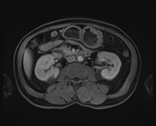 File:Bouveret syndrome (Radiopaedia 61017-68856 Axial T1 C+ fat sat 47).jpg