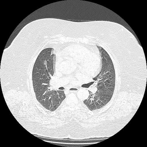 Bovine aortic arch - right internal mammary vein drains into the superior vena cava (Radiopaedia 63296-71875 Axial lung window 75).jpg
