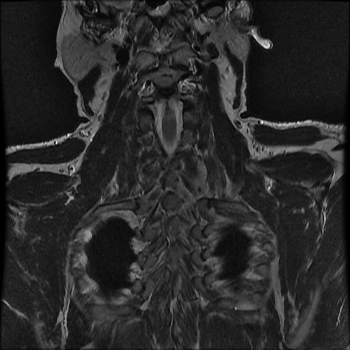 File:Brachial plexus neurofibroma (Radiopaedia 28030-28291 Coronal T2 1).png