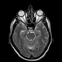 File:Brain abscess complicated by intraventricular rupture and ventriculitis (Radiopaedia 82434-96571 Axial T2 8).jpg