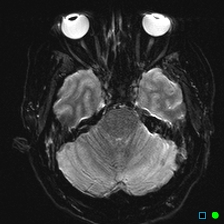 File:Brain death on MRI and CT angiography (Radiopaedia 42560-45689 Axial ADC 11).jpg