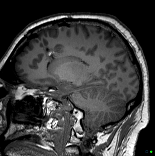 Brain death on MRI and CT angiography (Radiopaedia 42560-45689 Sagittal T1 39).jpg