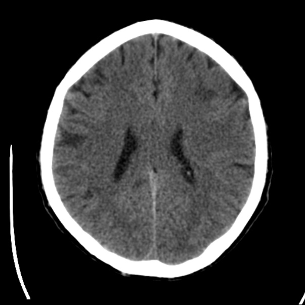 Brain metastases from lung cancer (Radiopaedia 24480-24781 Axial non-contrast 31).jpg
