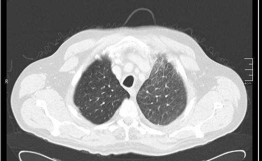 Brain metastases from squamocellular lung cancer (Radiopaedia 56515-63219 Axial lung window 17).jpg