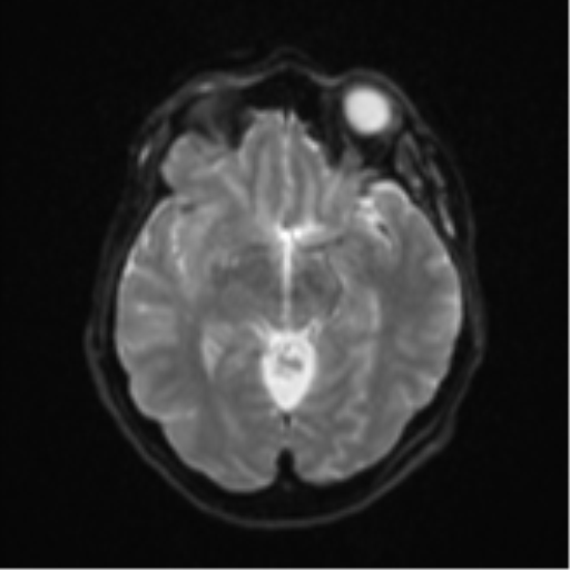 Brain metastasis (sarcoma) (Radiopaedia 47576-52209 Axial DWI 12).png