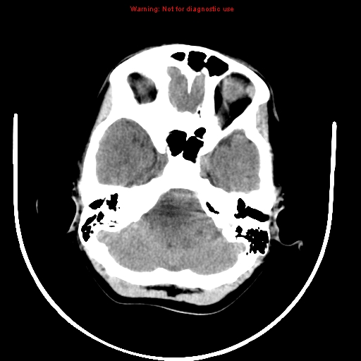 File:Brainstem glioma (Radiopaedia 9444-10123 non-contrast 3).jpg