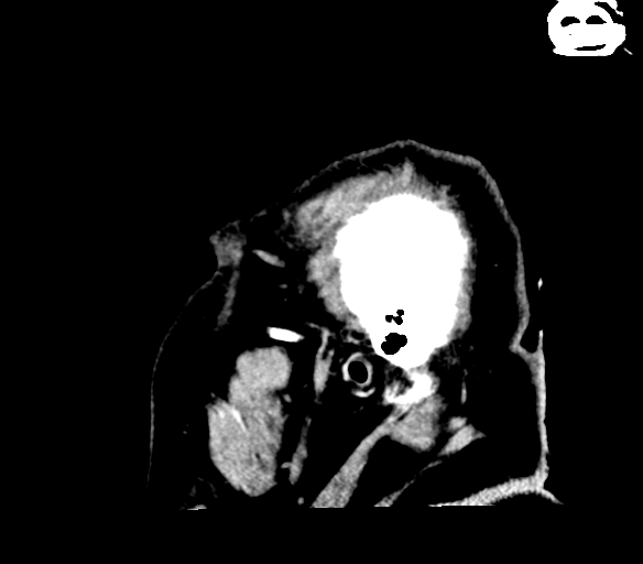 Brainstem hemorrhage (Radiopaedia 81294-94976 C 1).jpg