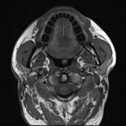 File:Branchial cleft cyst (Radiopaedia 31167-31876 Axial T1 19).jpg
