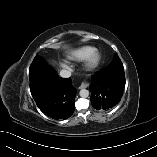 Breast carcinoma with pathological hip fracture (Radiopaedia 60314-67974 B 5).jpg