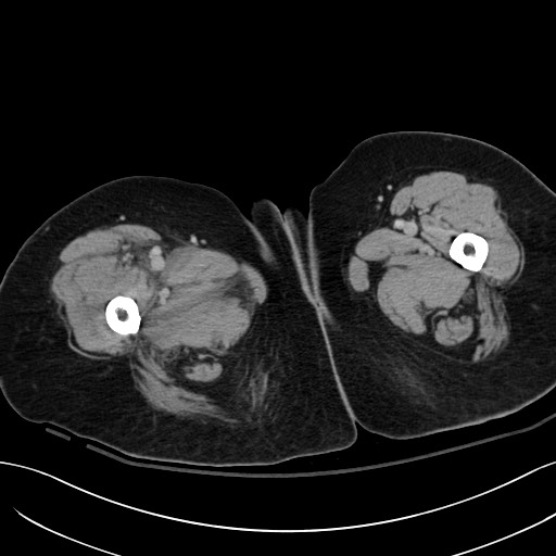 Breast carcinoma with pathological hip fracture (Radiopaedia 60314-67974 B 87).jpg