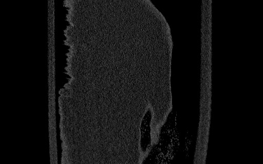 Breast carcinoma with pathological hip fracture (Radiopaedia 60314-67993 Coronal bone window 106).jpg