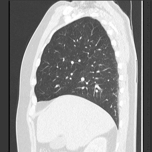 Bronchial carcinoid tumor (Radiopaedia 67377-76764 Sagittal lung window 20).jpg