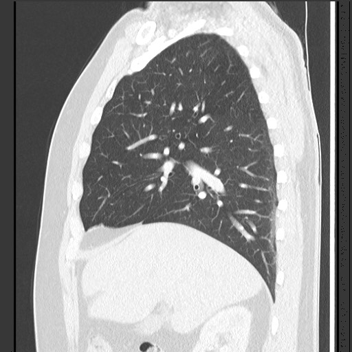 File:Bronchial carcinoid tumor (Radiopaedia 67377-76764 Sagittal lung window 23).jpg
