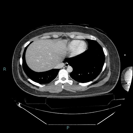 Bronchial carcinoid tumor (Radiopaedia 78272-90870 C 94).jpg