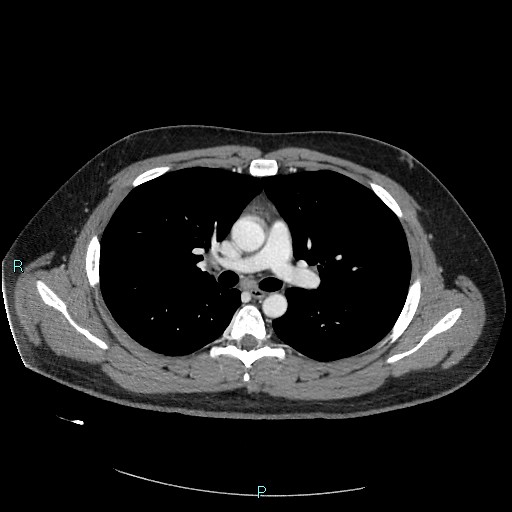 Bronchial carcinoid tumor (Radiopaedia 78272-90875 A 44).jpg