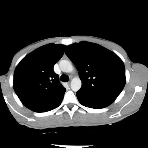 Bronchial carcinoid tumor causing right lower lobe collapse (Radiopaedia 83495-98594 A 15).jpg