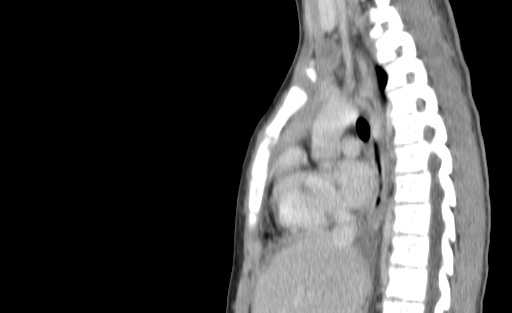 Bronchial mucoepidermoid carcinoma (Radiopaedia 57023-63895 Sagittal 122).jpg