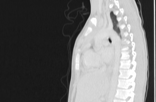 Bronchial mucoepidermoid carcinoma (Radiopaedia 57023-63895 Sagittal lung window 96).jpg