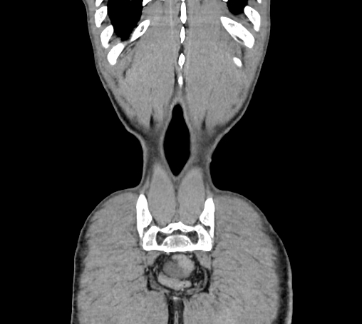 File:Bronchiectasis in Crohn disease (Radiopaedia 60311-67977 C 82).jpg