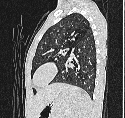 Bronchiolitis obliterans (Radiopaedia 71538-81897 Sagittal lung window 50).jpg