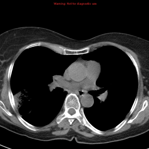 File:Bronchoalveolar carcinoma (BAC) (Radiopaedia 13436-13392 Axial non-contrast 26).jpg