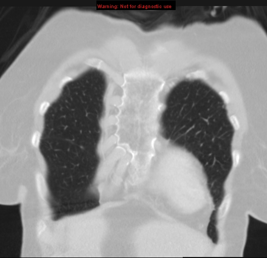 File:Bronchoalveolar carcinoma (BAC) (Radiopaedia 13436-13392 Coronal lung window 10).jpg