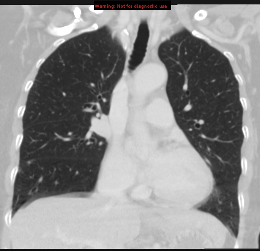 File:Bronchoalveolar carcinoma (BAC) (Radiopaedia 13436-13392 Coronal lung window 25).jpg