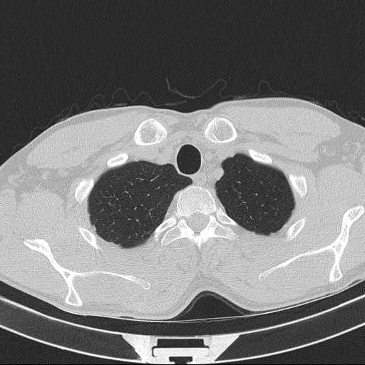 Bronchocele (Radiopaedia 60676-68429 Axial lung window 7).jpg
