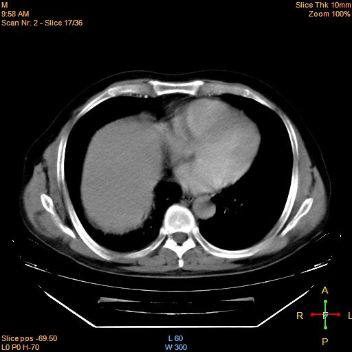 File:Bronchogenic carcinoma with superior vena caval invasion (Radiopaedia 22378-22406 Axial liver window 15).jpg