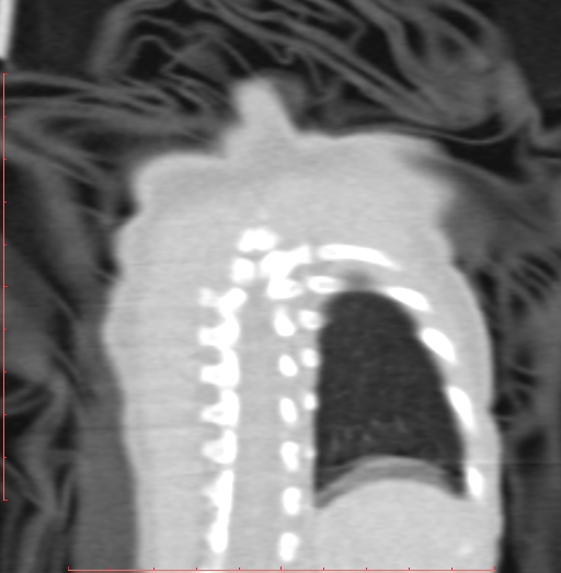 Bronchogenic cyst (Radiopaedia 78599-91409 Coronal lung window 201).jpg