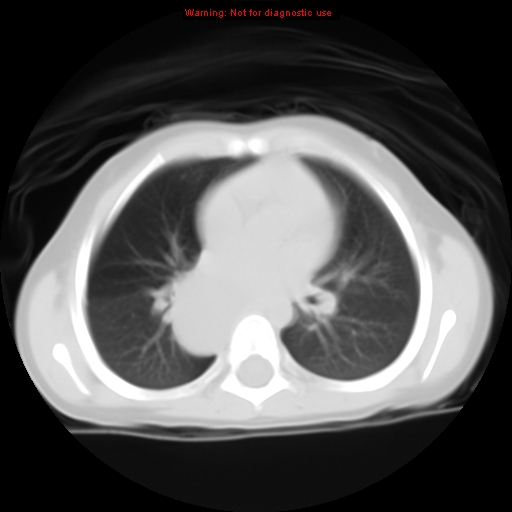 File:Bronchogenic cyst (Radiopaedia 9372-10063 Axial lung window 9).jpg