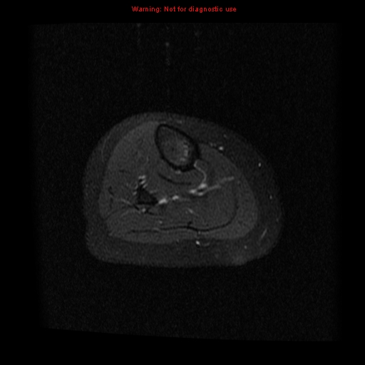 File:Brown tumor (Radiopaedia 12318-12597 Axial T1 C+ fat sat 27).jpg
