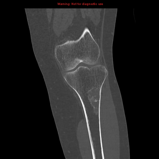 File:Brown tumors (Radiopaedia 9666-10291 Coronal bone window 15).jpg