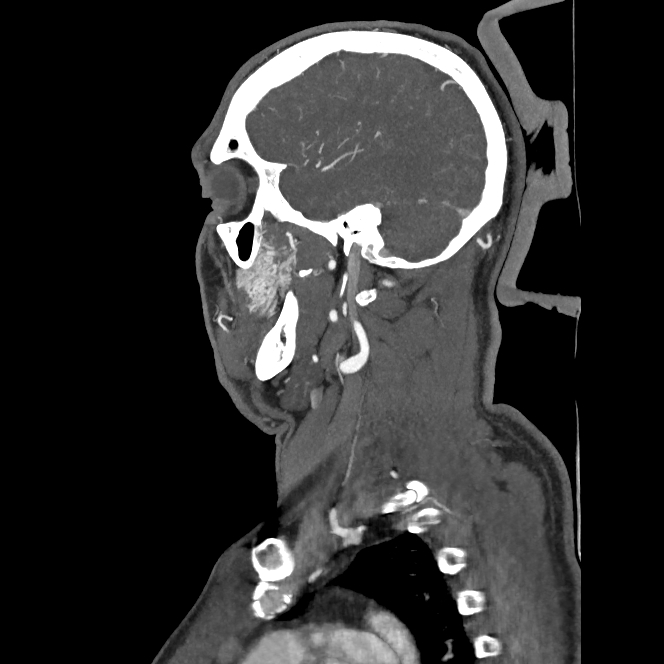 Buccal fat pad arteriovenous malformation (Radiopaedia 70936-81144 C 34).jpg