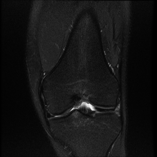 File:Bucket-handle meniscus tear (Radiopaedia 65700-74809 Coronal T2 fat sat 12).jpg