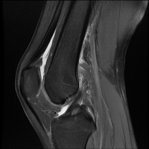 File:Bucket-handle meniscus tear (Radiopaedia 65700-74809 Sagittal PD fat sat 12).jpg