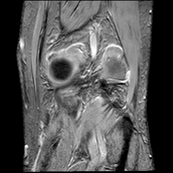 File:Bucket handle tear - medial meniscus (Radiopaedia 29250-29664 B 18).jpg