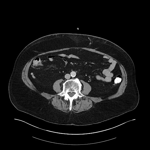 File:Buried bumper syndrome - gastrostomy tube (Radiopaedia 63843-72575 A 56).jpg