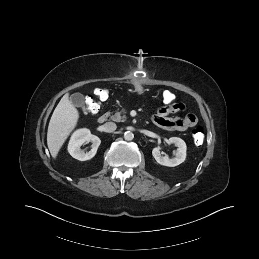 File:Buried bumper syndrome - gastrostomy tube (Radiopaedia 63843-72575 Axial 9).jpg