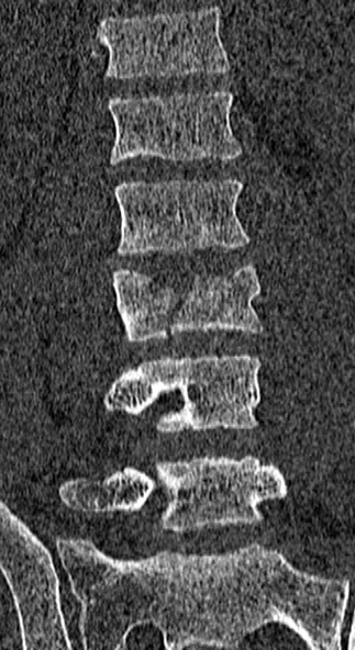 Burst fracture (Radiopaedia 53373-59357 Coronal bone window 37).jpg