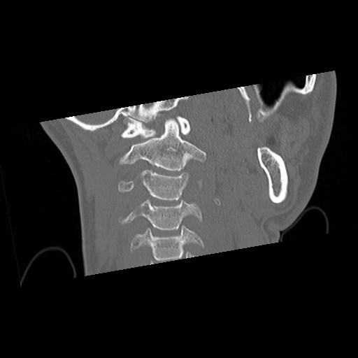 C1-C2 "subluxation" - normal cervical anatomy at maximum head rotation (Radiopaedia 42483-45607 Coronal non-contrast 18).jpg