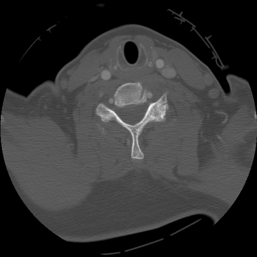 File:C1 anterior arch (plough) fracture - type 1 (Radiopaedia 76181-87720 Axial bone window 56).jpg