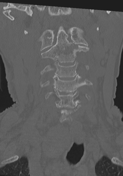 C2 fracture with vertebral artery dissection (Radiopaedia 37378-39199 Coronal bone window 11).png
