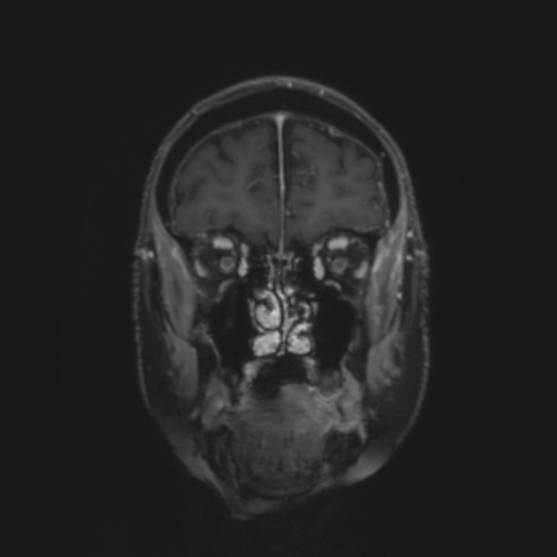 CNS lymphoma with steroid response (Radiopaedia 37980-39921 Coronal T1 C+ 5).png