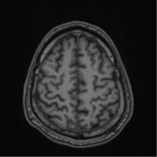 CNS vasculitis (Radiopaedia 55715-62263 Axial T1 77).png