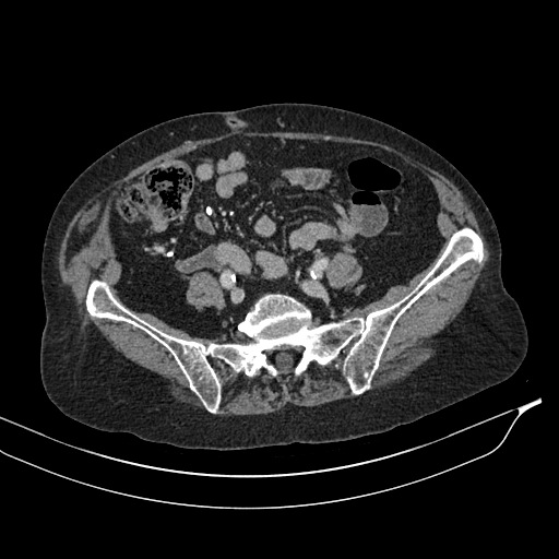 Calcified adrenal glands and Spigelian hernia (Radiopaedia 49741-54988 A 160).jpg