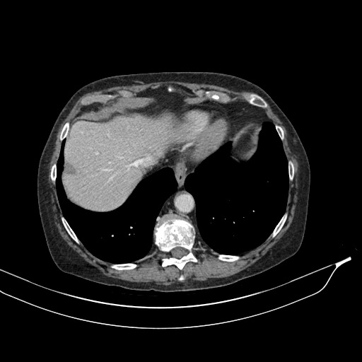 Calcified adrenal glands and Spigelian hernia (Radiopaedia 49741-54988 A 25).jpg